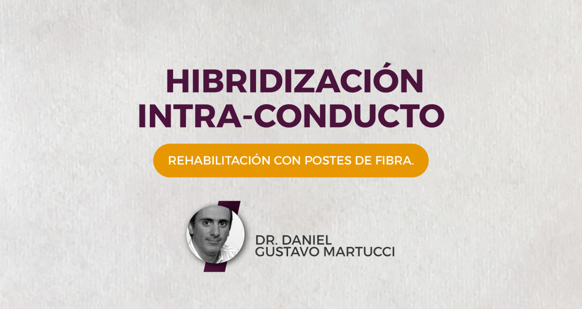 imagen Hibridización intra-conducto. Rehabilitación con postes de fibra