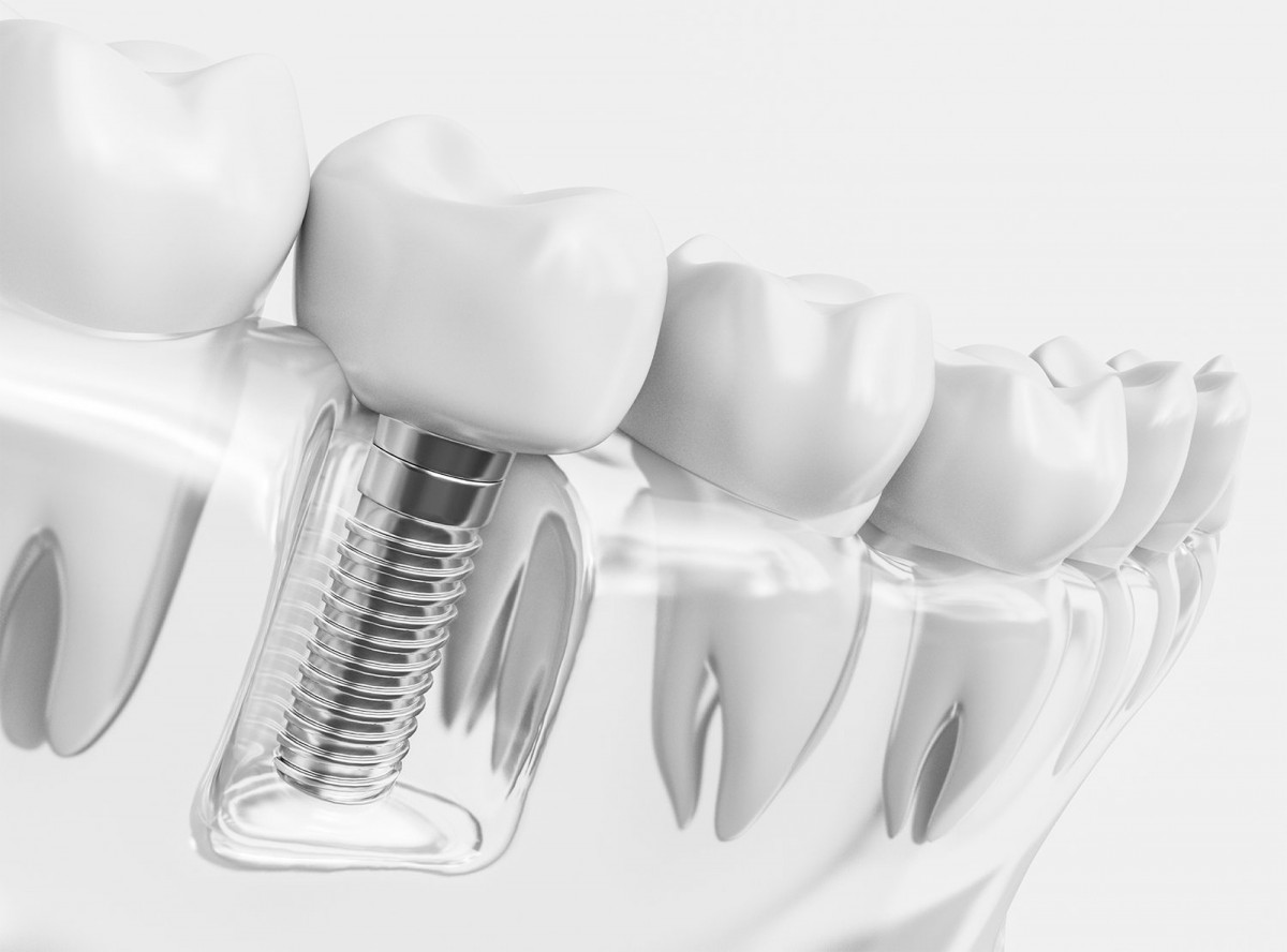 imagen Implantología Oral