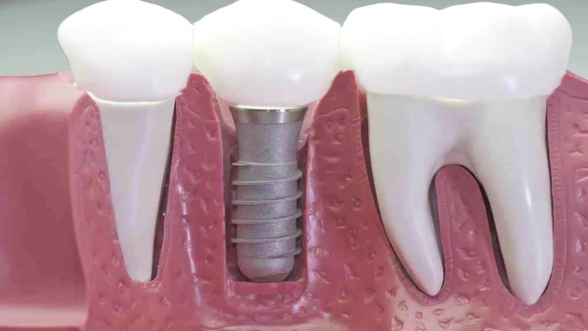 imagen Rehabilitación Oral con Implantes 1° Nivel