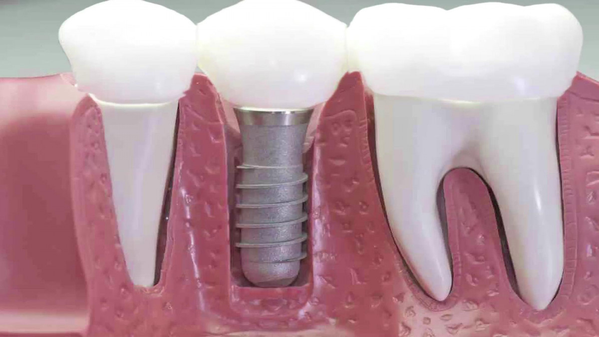 imagen Rehabilitación Oral con Implantes 1° Nivel