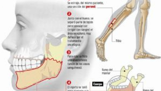 imagen Docente de la Facultad realizó en Mendoza la primera cirugía de reconstrucción de mandíbula