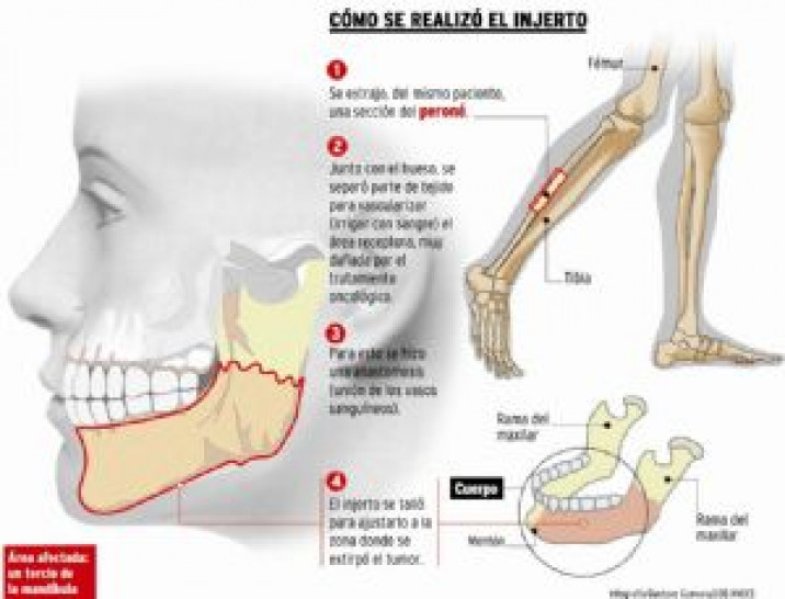 imagen Docente de la Facultad realizó en Mendoza la primera cirugía de reconstrucción de mandíbula